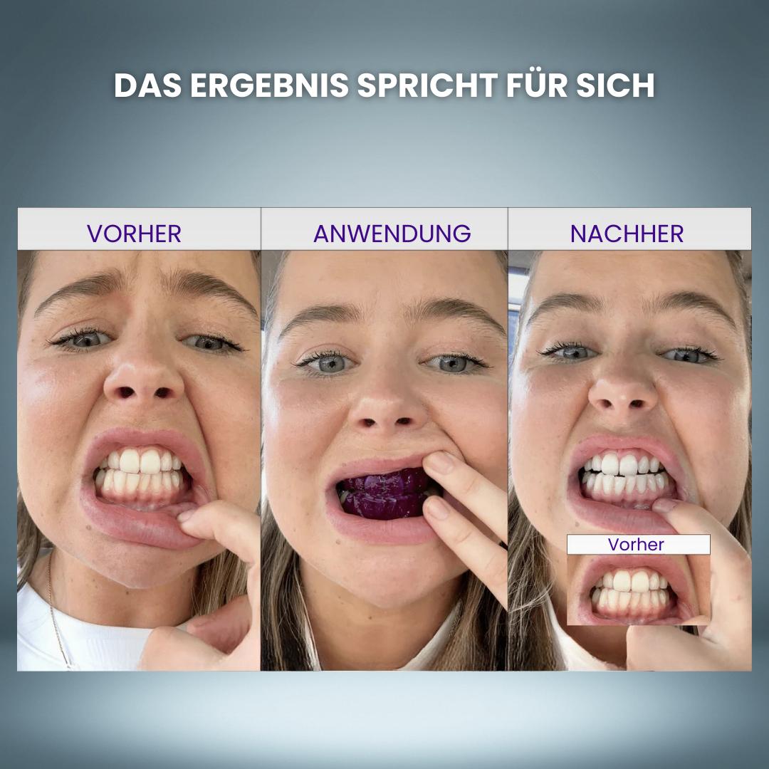 Hismile Zahnaufhellung